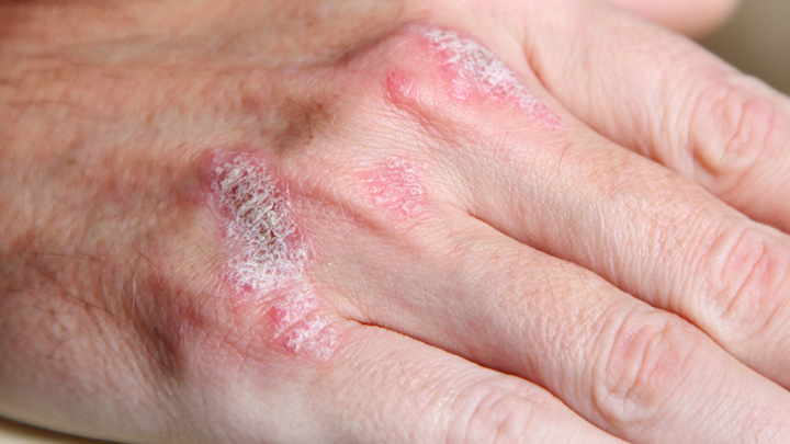 091215_psoriasis_hand