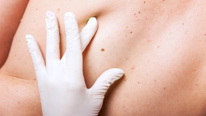 190216_skin check_mole_freckle