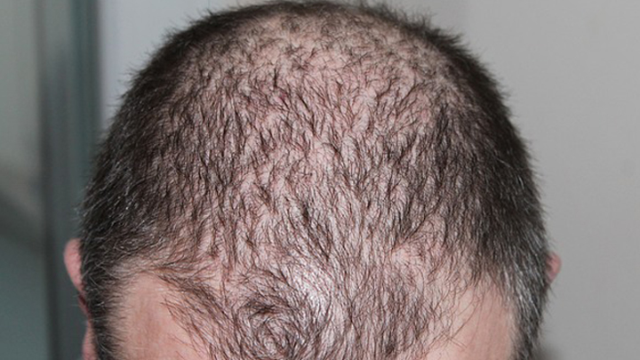 hairloss