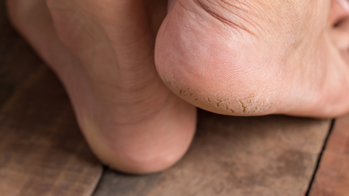 Cracked heels
