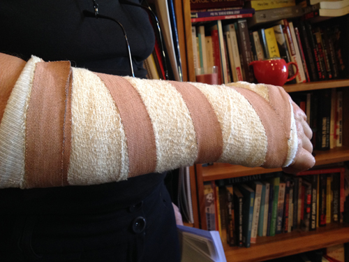 Why breaking my arm was a triumph, not a disaster - Starts at 60