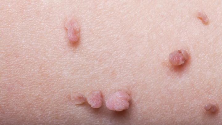 are vaginal skin tags common