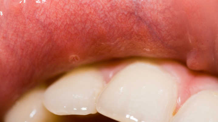 cure-your-mouth-ulcers-at-home-easily-with-these-natural-solutions