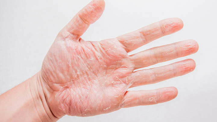 Gently recover your dry peeled hands | Starts at 60