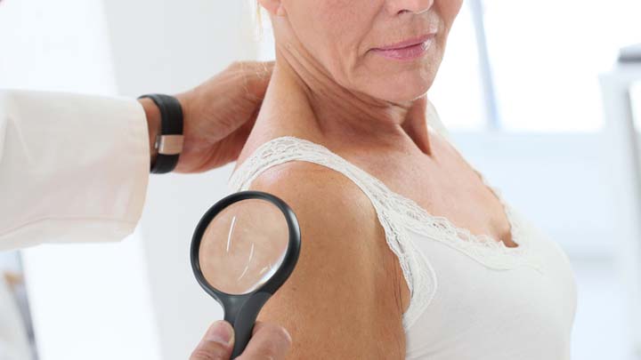 121115_skin_cancer_check