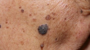 Melanoma-on-the-face