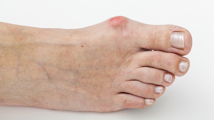 300316_bunion