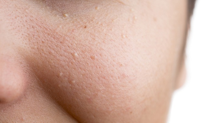 what-those-white-spots-are-under-your-eyes-and-how-to-get-rid-of-them