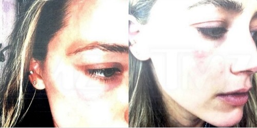 Amber produced these photos, showing her bruised face. Photo: TMZ