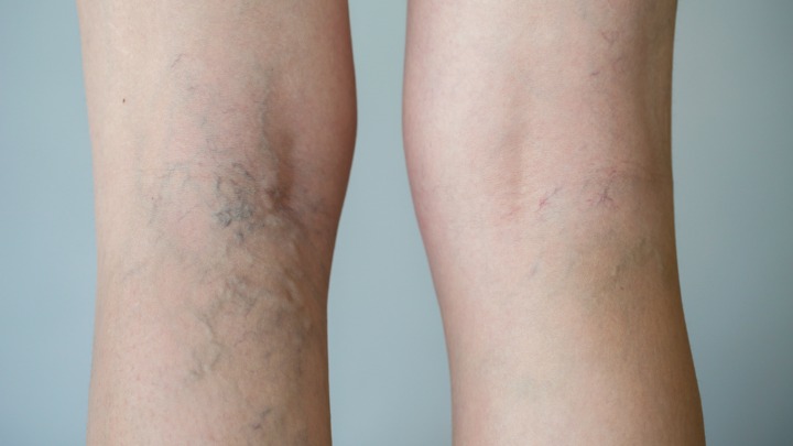 160807_Varicose-Veins_720x405