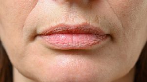 Are you suffering from dry and cracked lips? This is your answer!