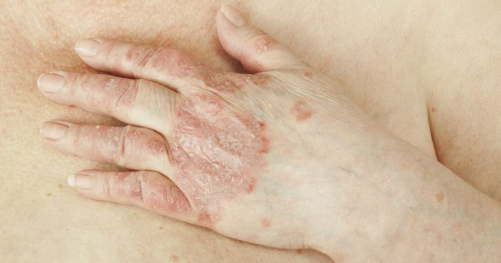 161029_psoriasis