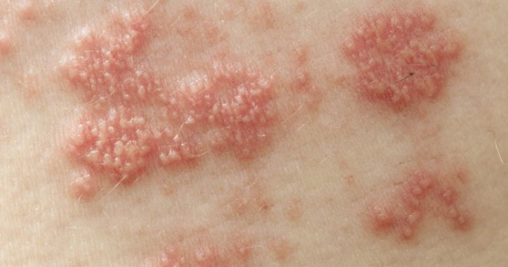 311016_shingles-rash