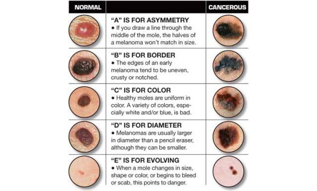 Mole Chart For Skin Cancer