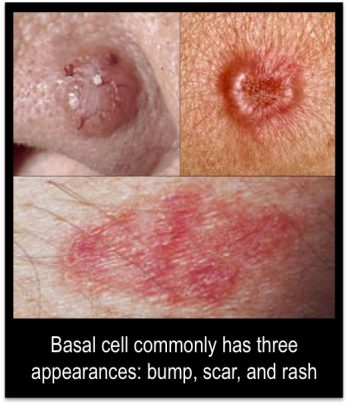 Basal Cell Carcinoma. Photo via Pinterest.