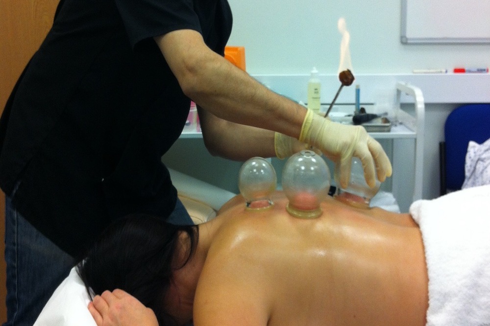 A woman receives a cupping treatment