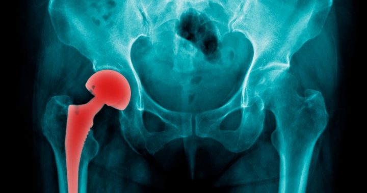 hip replacement hip replacement x-ray