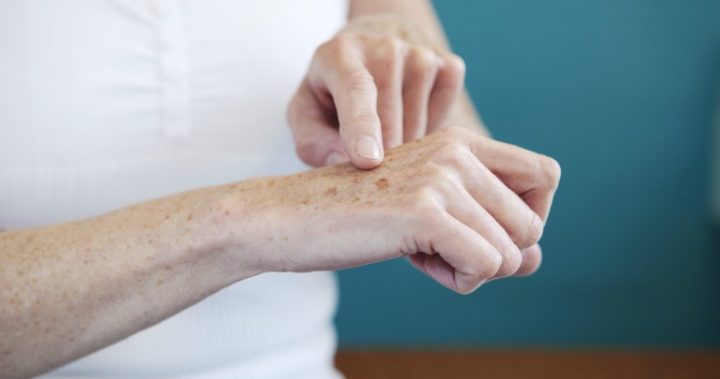 age spots age spots