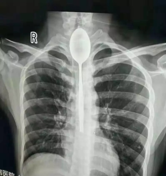 x-ray stuck in man's throat