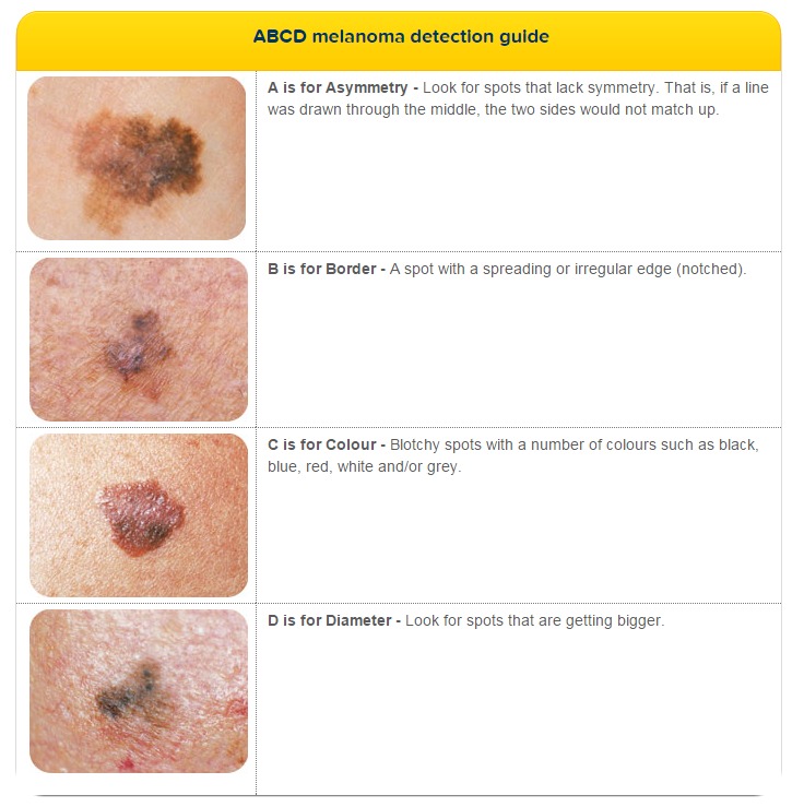 melanoma detection guide