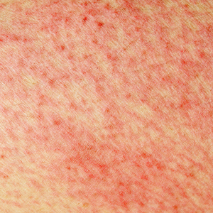 When a rash is more than ‘just a rash’? – Starts at 60