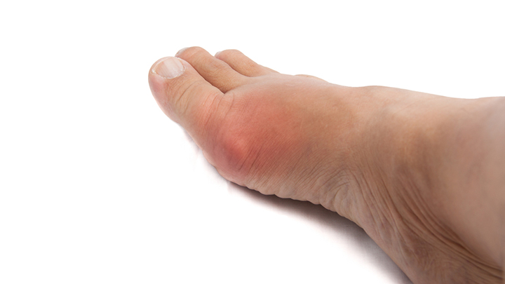 shutterstock_232806628_gout